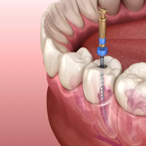 Endodoncia4
