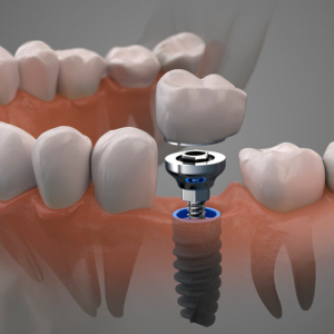Implantes4